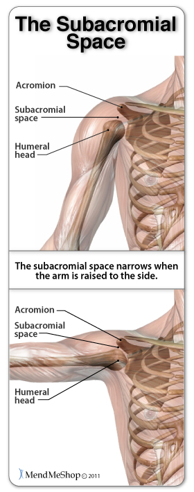 Shoulder Impingement Syndrome occurs when the subacromial space lesses due to misalignment, abnormal bone growths, thickening of the tendon, or swelling in the bursa.