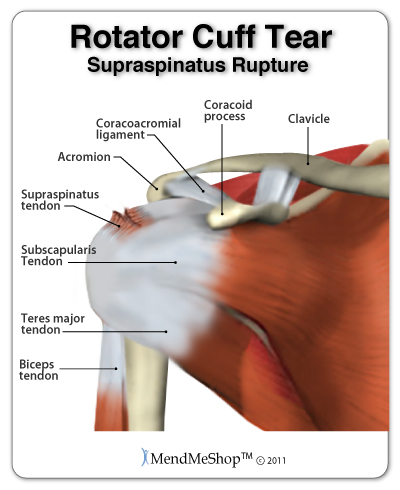 Chronic degeneration or a acute trauma can tear a rotator cuff tendon, usually the supraspinatus tendon.
