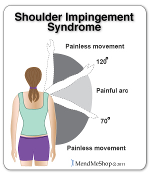 Shoulder Impingement Syndrome causes a painful arc between 70°  and 120° . Treating the swelling and inflammation early can reduce the risk of busitis, tendinitis, bone spurs, and calcification of the tendon.