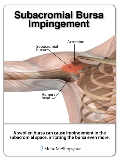 Impingement can occur when the bursa and supraspinatus tendon become inflamed and swollen.